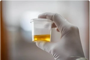 Chẩn đoán ung thư qua kiểm tra nước tiểu