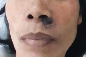 Nốt ruồi nho nhỏ mà gây họa lớn