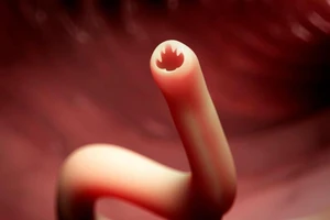 Ngồi trên bãi biển, bị giun chui từ mông lên phổi