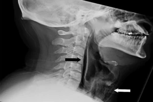 Rách cổ họng vì cố nhín hắt hơi