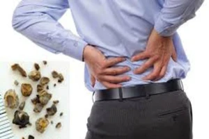 Cách hô biến sỏi thận nhanh khó ngờ