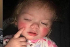 Lạ kỳ bé gái dị ứng với mồ hôi của chính mình