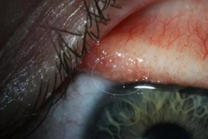 Phát hiện giun lạ sống trong mắt người