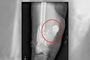 Nhờ cảnh sát lấy pháo hoa trong đùi bệnh nhân