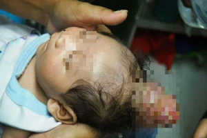 Cậu bé mọc 'sừng' trên đầu như kỳ lân