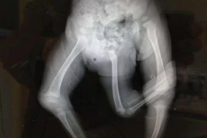 Kỳ lạ cậu bé sinh ra đã có 3 chân