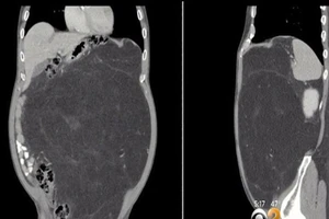 Tưởng 'bụng bia', hóa ra khối u 'khủng' 13 kg