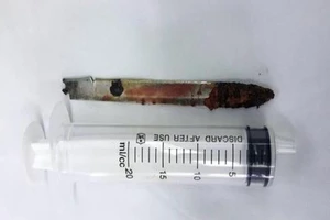 Lưỡi dao bị 'bỏ quên' trong... lưng bệnh nhân 11 năm