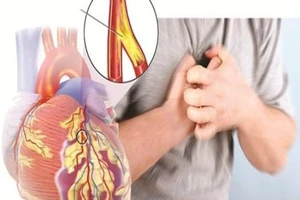 6 dấu hiệu cảnh báo sớm bệnh tim mạch