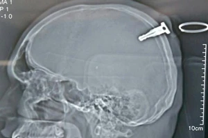 Bị chìa khóa xe máy cắm sâu vào đầu khi ẩu đả