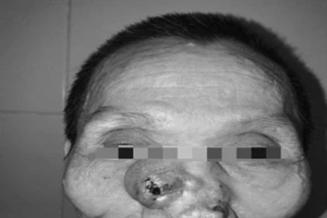 Tái tạo lại mũi, má cho bệnh nhân mắc bệnh ung thư 