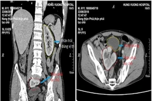Hy hữu: Đưa quả thận 'đi lạc' 61 năm về đúng vị trí