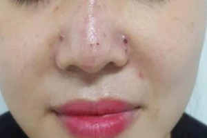 Thêm ca biến chứng sau khi tiêm filler nâng mũi tại spa