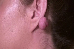 Mang 2 cục u khổng lồ sau khi xỏ lỗ tai