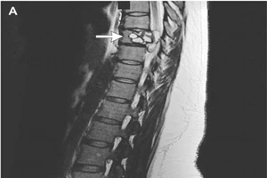 Bị ‘điện giật’ liên tục do sán dây chui vào cột sống