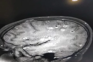 Kinh hoàng: Não bé 8 tuổi có 100 trứng sán dây