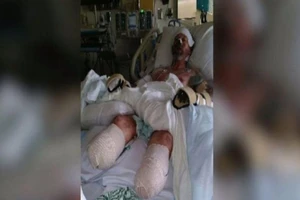 Cắt bỏ tứ chi vì nhiễm khuẩn từ nước bọt chó cưng