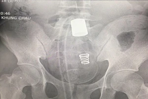 Lấy vòi xịt vệ sinh dài 45 cm từ hậu môn nam thanh niên