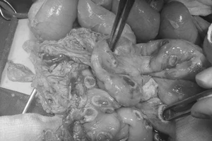 'Sốc nặng': Ruột bé trai thủng 50 lỗ vì nhiễm ấu trùng giun