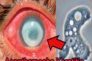 Nguy cơ bị mù do ký sinh trùng có trong nước máy