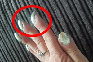 Khám móng tay quặp, được thông báo ung thư phổi