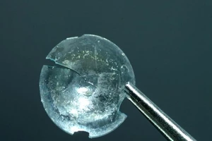 Kính sát tròng rơi ngược vào mắt 28 năm sau va chạm