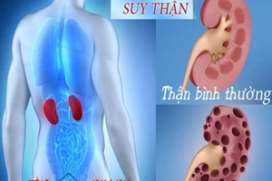 Dấu hiệu nhận biết suy thận