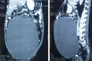 Bàng quang tích 11 lít nước do bị tiểu đường