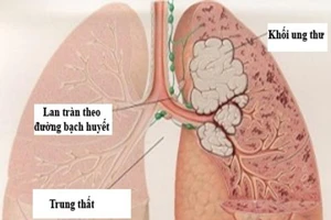 Những dấu hiệu 'tố' bệnh ung thư phổi