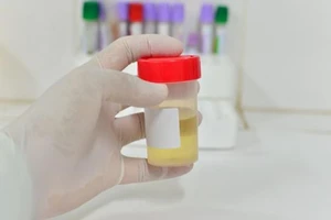 4 dấu hiệu mách bạn có vấn đề bàng quang