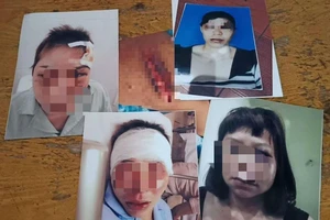 Tâm sự cay đắng của người vợ bị chồng cắt gân chân