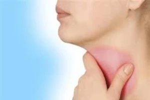 Thuốc gì trị viêm họng đỏ cấp?