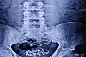 Nhét dây điện vào 'của quý', lọt đến tận bàng quang