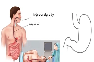 Những ai không nên nội soi dạ dày?