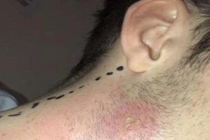 Nam sinh 17 tuổi suýt chết vì nặn mụn