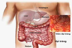 Những thực phẩm người bị viêm đại tràng mạn tính cần tránh