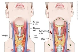 Ung thư vòm họng (Hình minh họa)