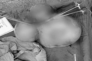 Phẫu thuật bóc thành công khối u xơ tử cung nặng 5,5 kg 