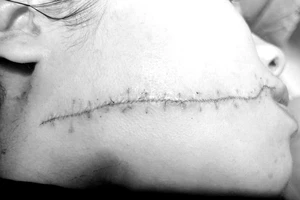 Cứu gương mặt cô gái có vết rách dài được khâu như con rết