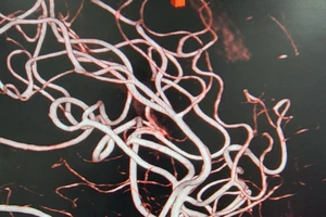 Cứu sống cụ già 81 tuổi đột ngột đau đầu dữ dội