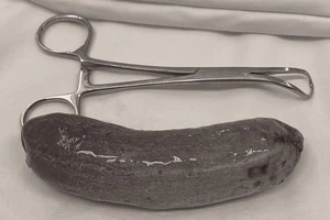 Sửng sốt dị vật 'khủng' trong hậu môn nam thanh niên 19 tuổi