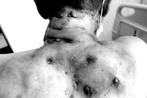 Mắc bệnh hiếm gặp, người đàn ông bị chảy mủ khắp người 