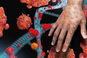 Bệnh đậu mùa khỉ: Ai dễ nhiễm và dễ bị bệnh nặng?