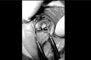 Người phụ nữ bị đâm vỡ thủy tinh thể khi cắt mí mắt ở thẩm mỹ viện 