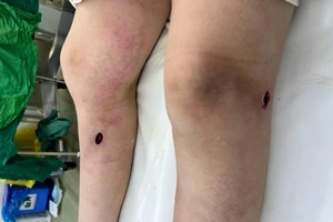  Đi spa làm đẹp, cô gái 20 tuổi xém hỏng cặp chân