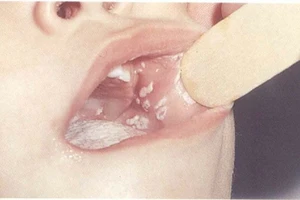 Nấm Candida : Những bệnh thường gặp