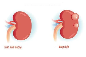 Nang thận, ai dễ mắc phải căn bệnh này?