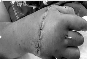 Cứu bàn tay đứt rời cho bé trai 12 tuổi