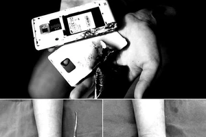 Nát bàn tay do điện thoại phát nổ 