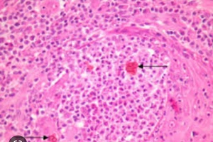 Nấm Chromoblastomycosis. Ảnh: internet